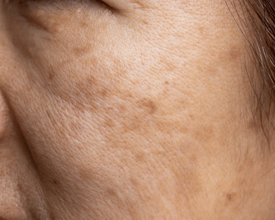 Symmetrical melasma patches on the cheeks and forehead