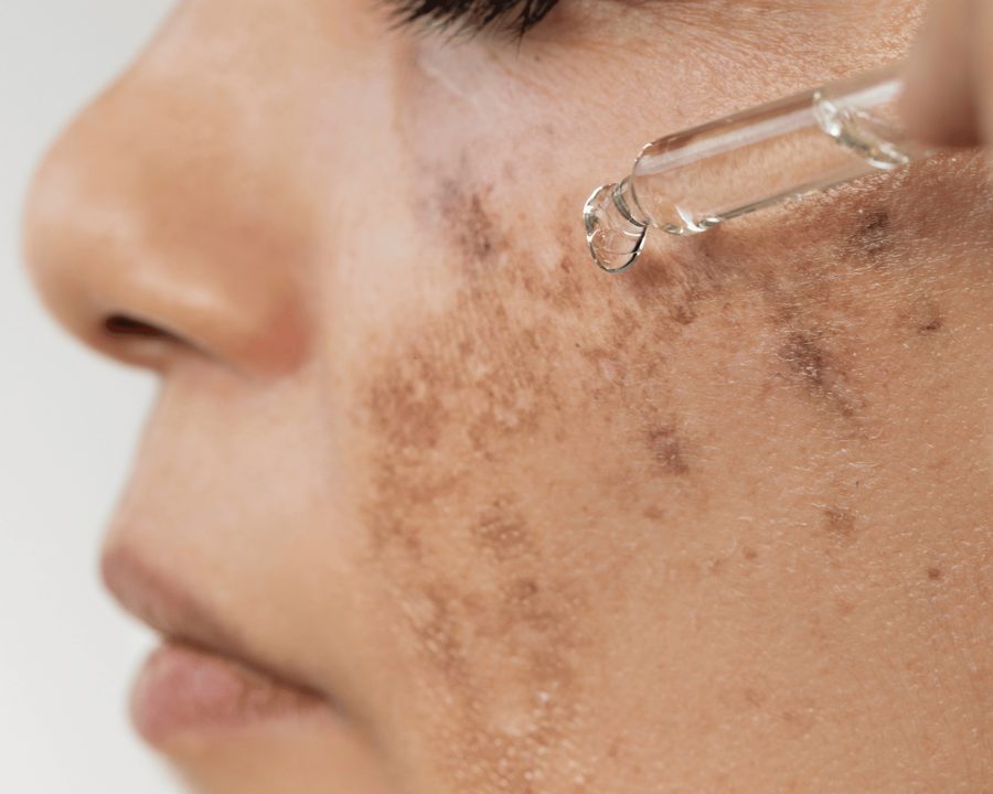 Topical skincare treatments used for melasma