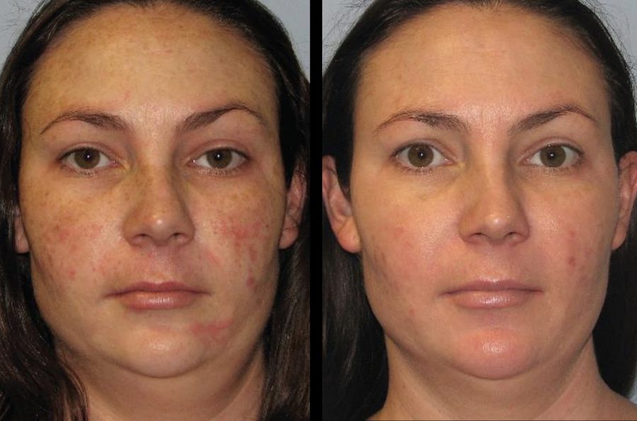 Before and after results of rosacea and redness treatment with BBL laser at The Piazza Center