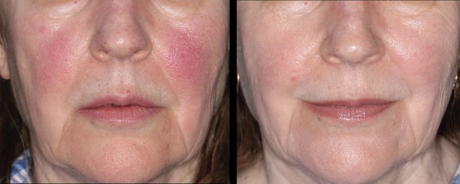 BBL laser rednesss treatment Rosacea BBL laser treatment