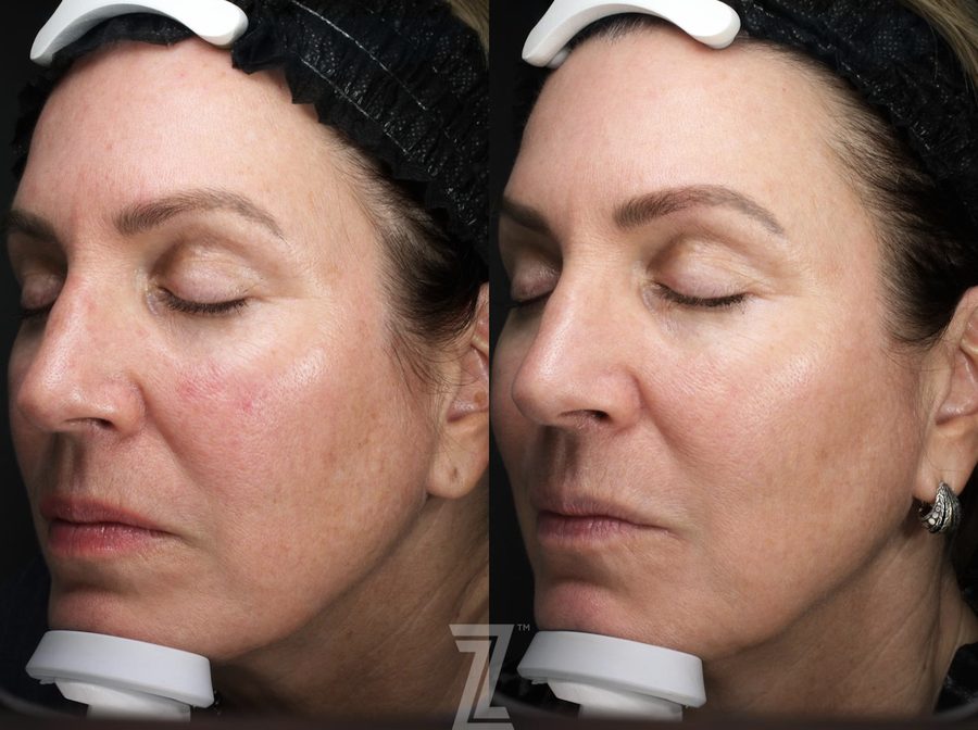 BBL + Moxi combo treatment for Rosacea Rosacea treatment BBL Moxi Laser