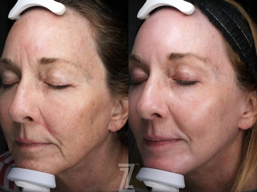 Before and after results after 3 BBL laser treatments at The Piazza Center