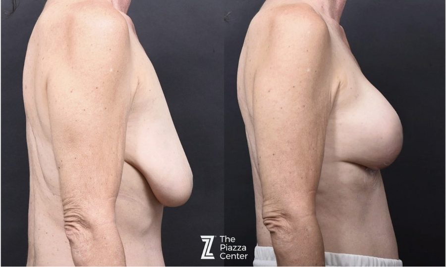 60-year-old breast lift with Motiva Preserv&eacute; case study, Austin