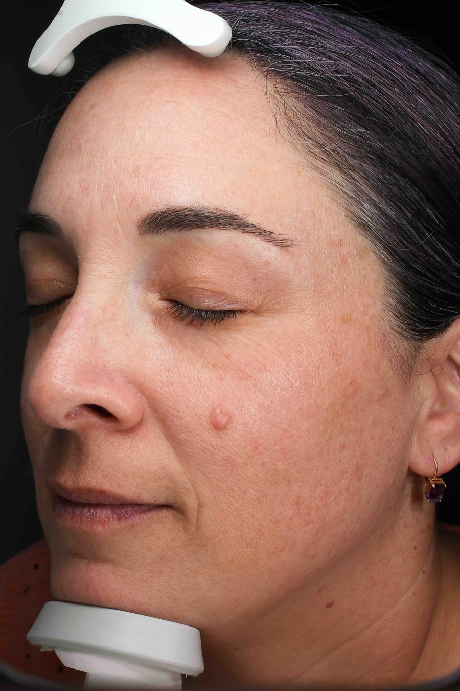 Patient after MOXI laser treatment at The Piazza Center