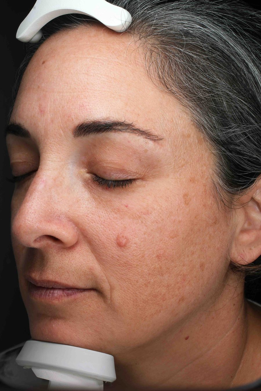 Patient before MOXI laser treatment at The Piazza Center