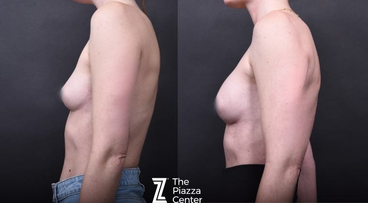 Motiva Preservé Implant Before and After DrPiazza Austin